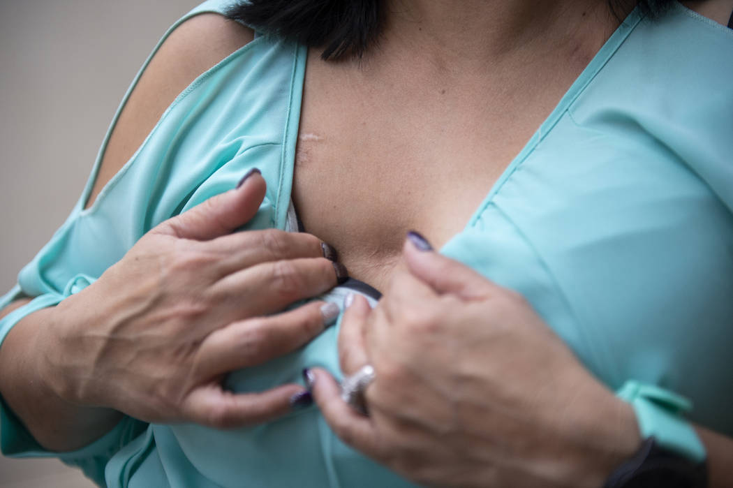 Melissa Tolentino muestra las cicatrices de su mastectomía doble en su casa de Las Vegas, el jueves 11 de octubre de 2018. A sus 50 años, Tolentino fue diagnosticada con cáncer de mama a los 40 ...